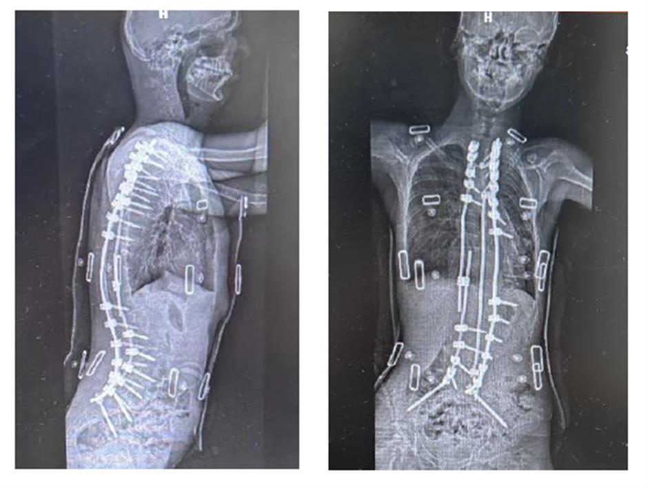 xinhua hospital surgeons straighten 14-year-old's spine