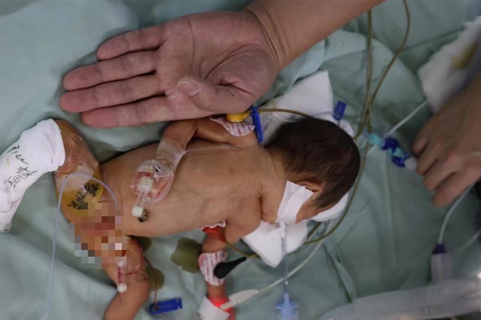 tiny baby discharged after world record surgery